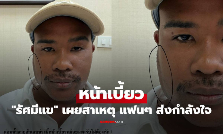 รัศมีแขหน้าเบี้ยว! ต่อมน้ำลายอักเสบ รักษาเรียบร้อย แฟนคลับส่งกำลังใจถล่มทลาย